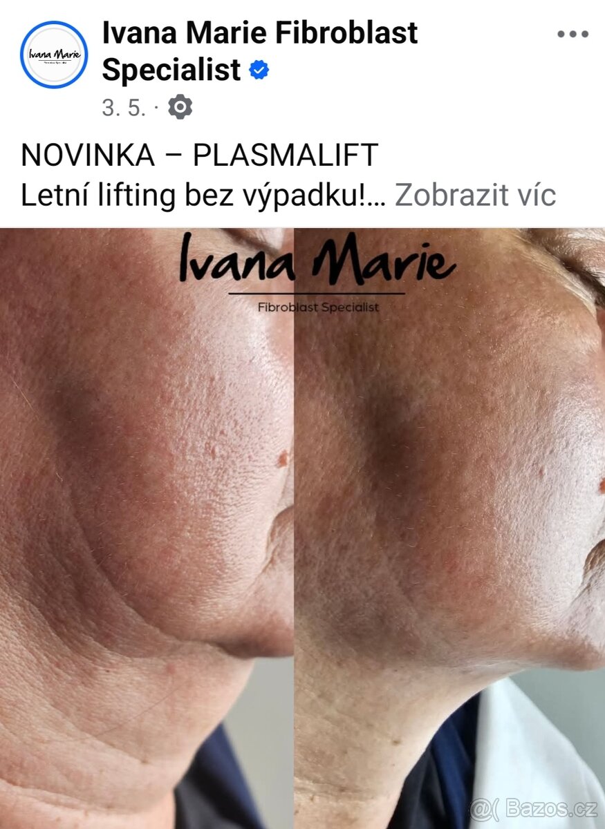 Poukázka plasmalift