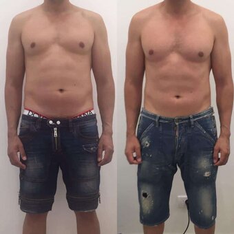 Laserová liposukceVerjú - 11