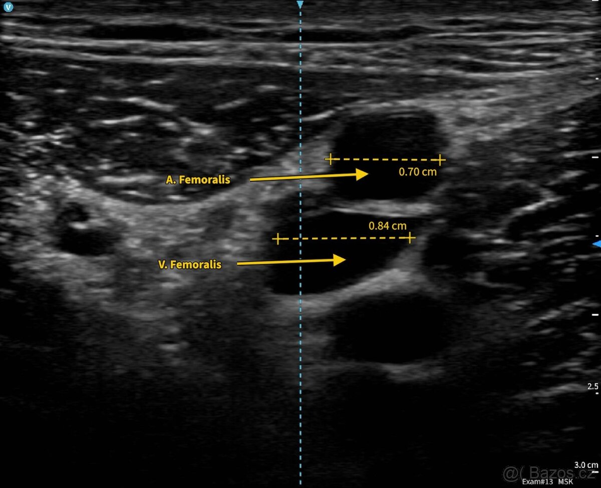 Ultrazvuk, Sono, V Scan Air SL - 4