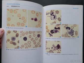 Myelodysplastický syndrom - 4