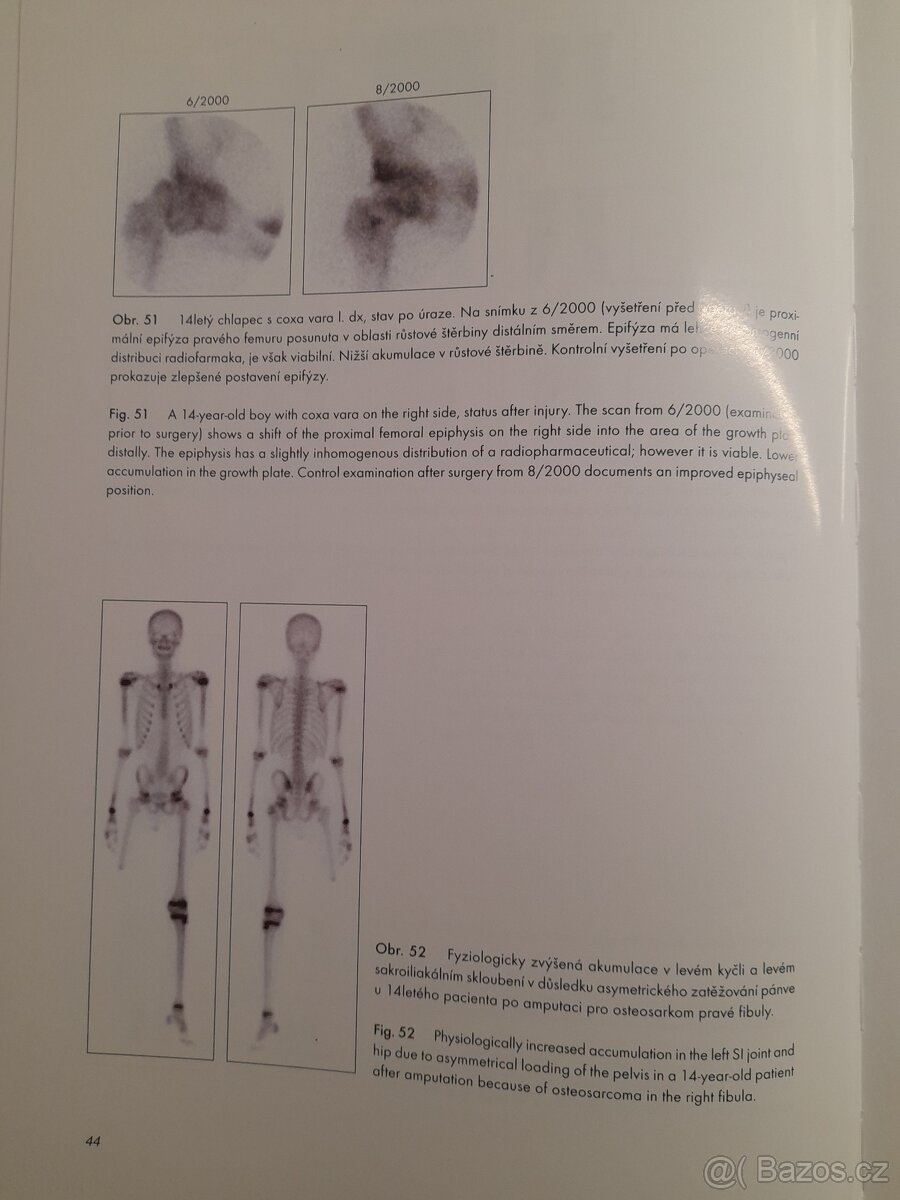 Atlas kostní scintigrafie - 5