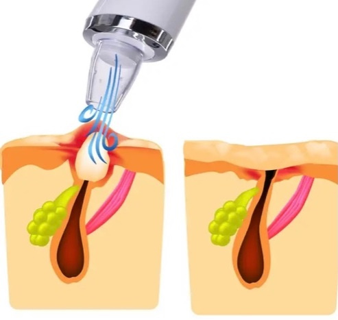 Vakuový čistič pleti na akné - plno různých nástavců - 6